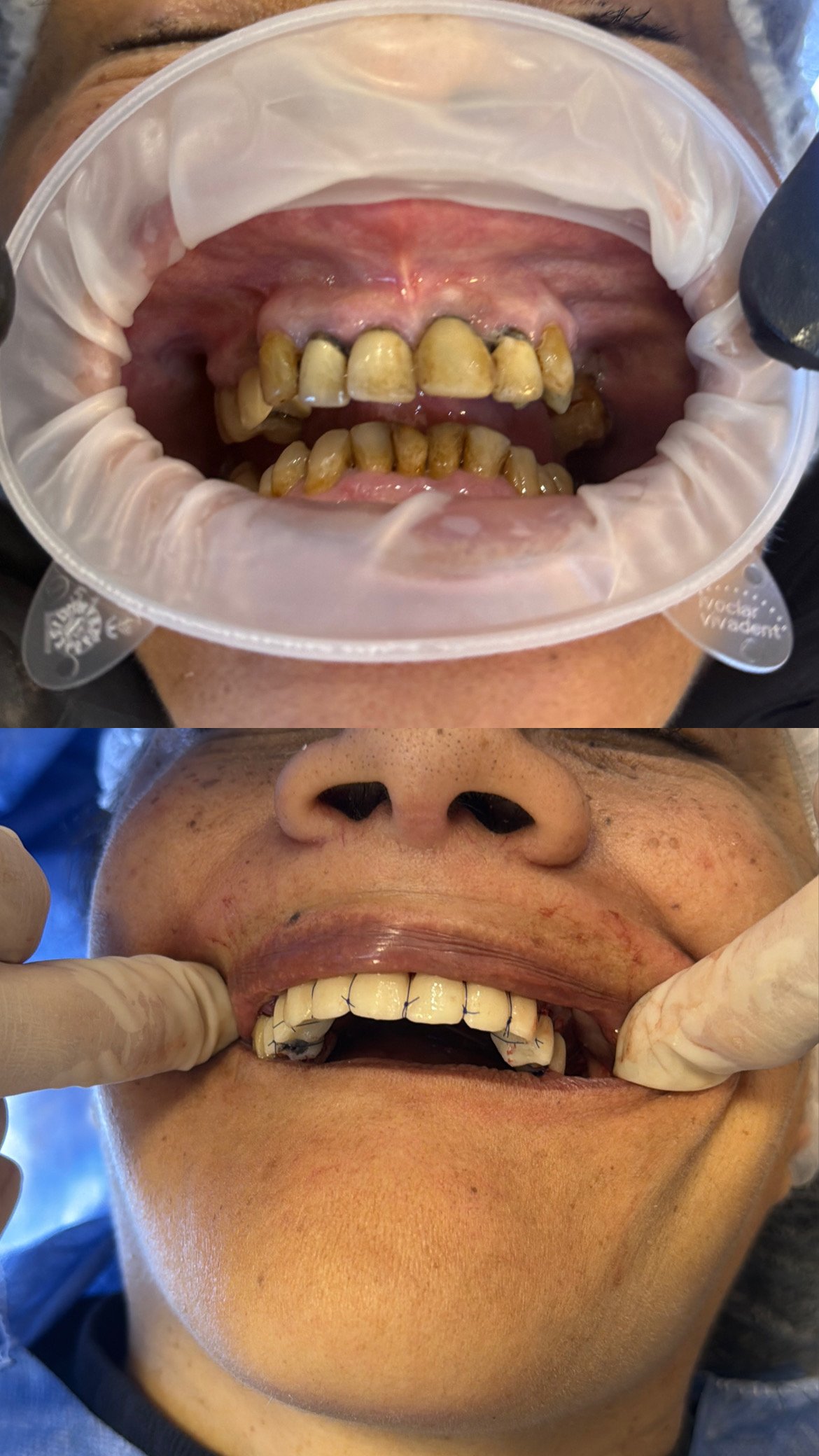 Antes y después — Patricia Ledesma